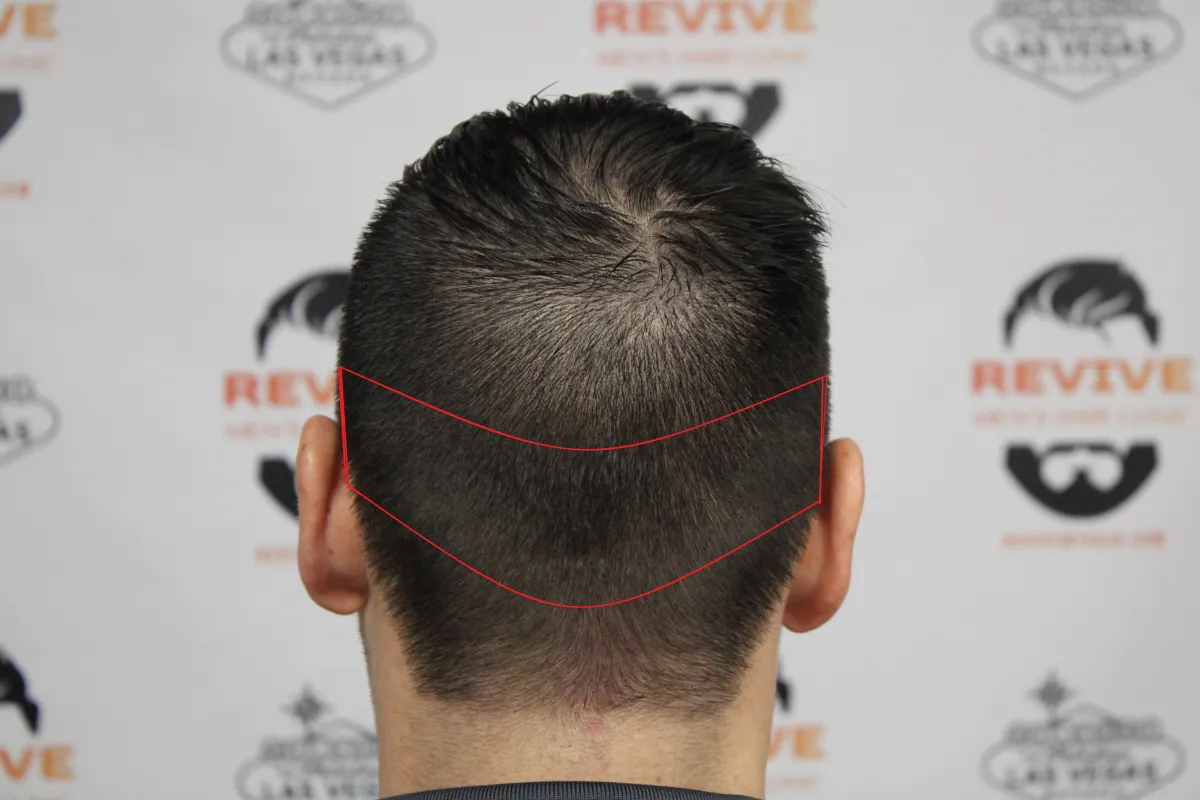 NeoGraft FUE donor extraction site at Revive Men's Hair Clinic Henderson Nevada