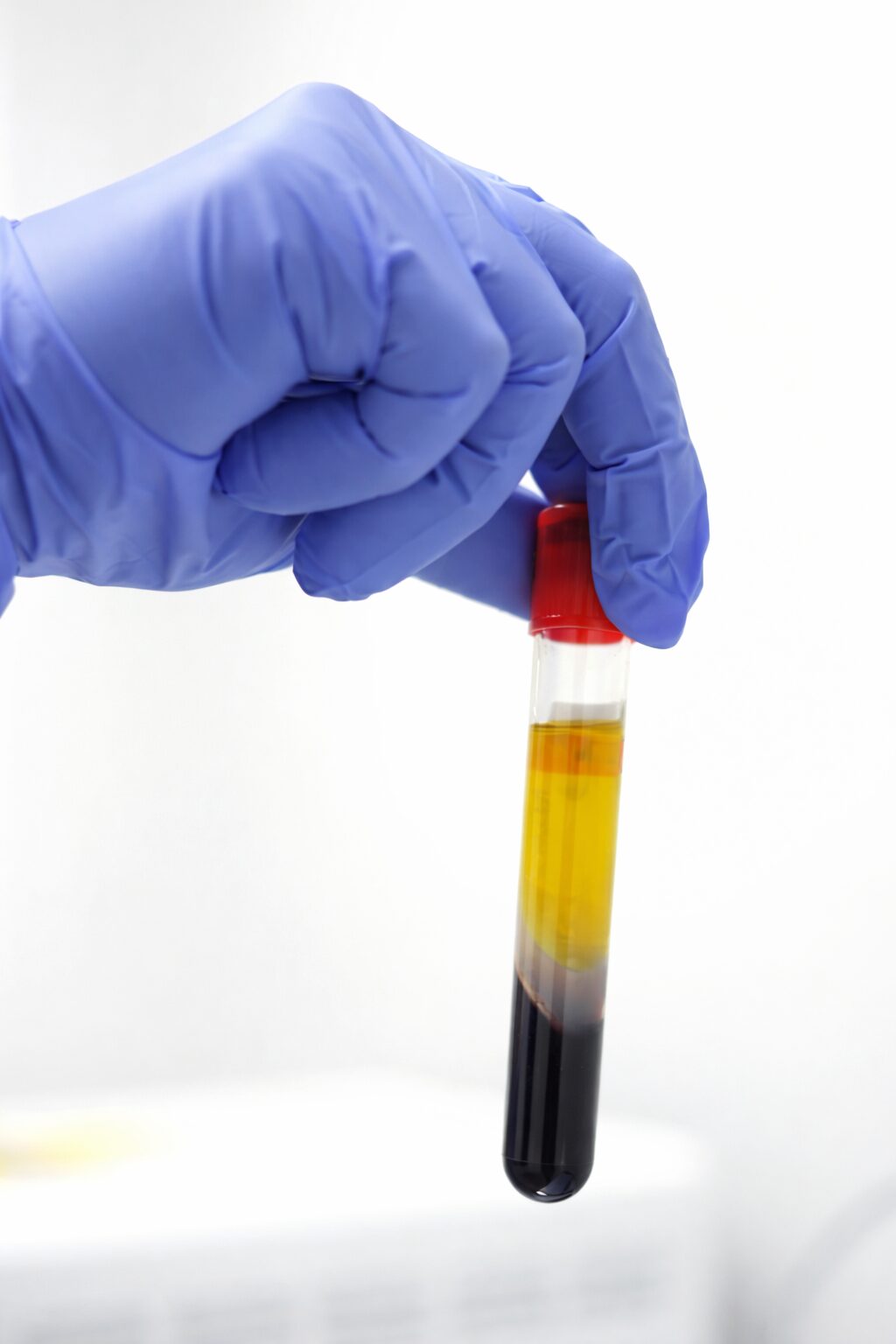 Separated platelet-rich plasma vial after centrifuge processing