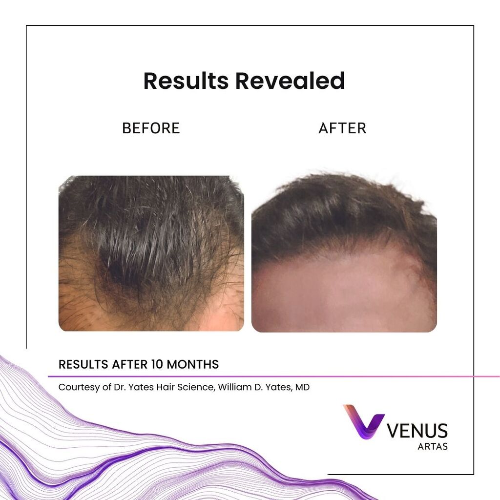 Representative ARTAS® iX robotic FUE before and after, example 1 of 4 — courtesy of Venus Concept, not a Revive patient