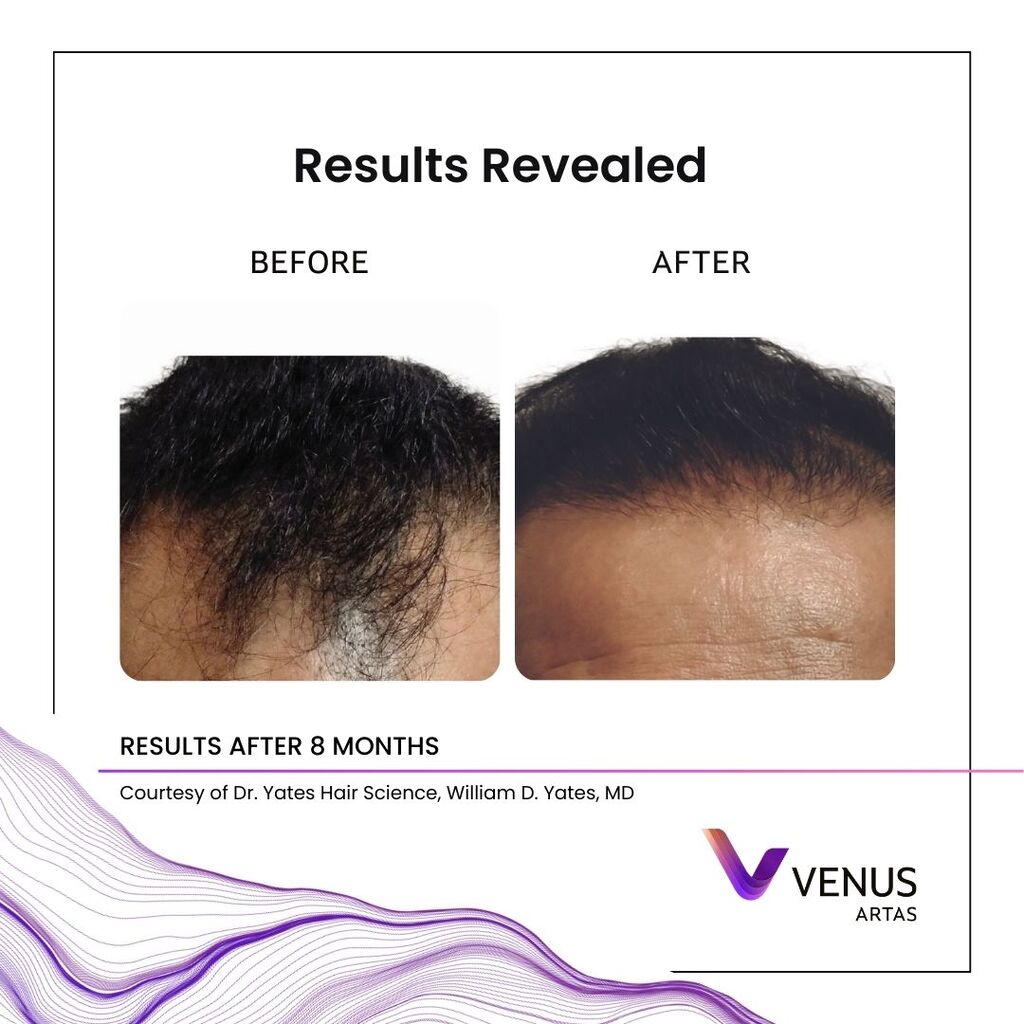 Representative ARTAS® iX robotic FUE before and after, example 2 of 4 — courtesy of Venus Concept, not a Revive patient