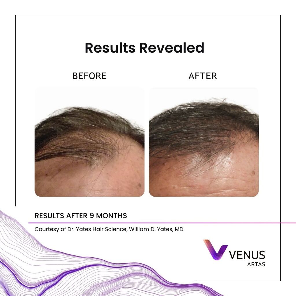 Representative ARTAS® iX robotic FUE before and after, example 3 of 4 — courtesy of Venus Concept, not a Revive patient