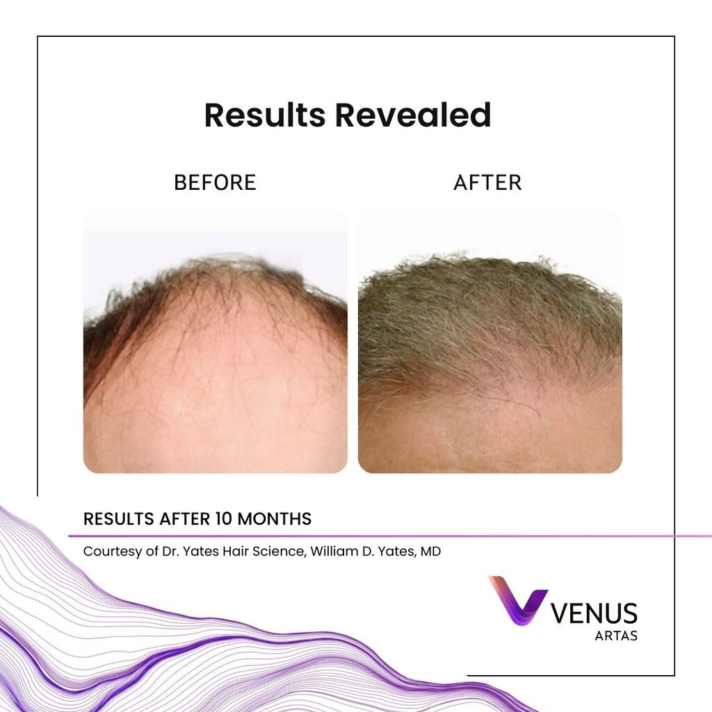 Representative ARTAS® iX robotic FUE before and after, example 4 of 4 — courtesy of Venus Concept, not a Revive patient