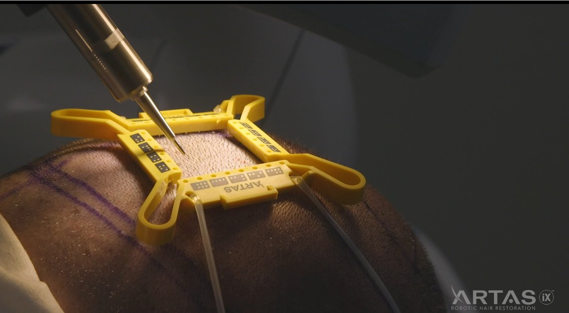 ARTAS iX robotic punch extracting follicular units from a tensioned donor area