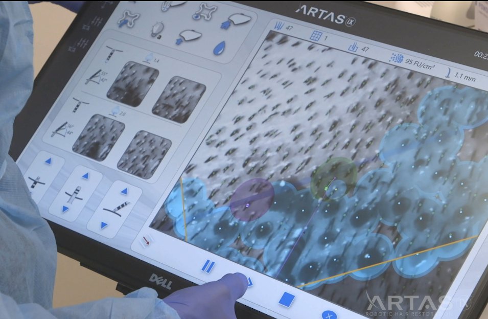 ARTAS iX console showing follicular unit selection and donor density readout during robotic FUE