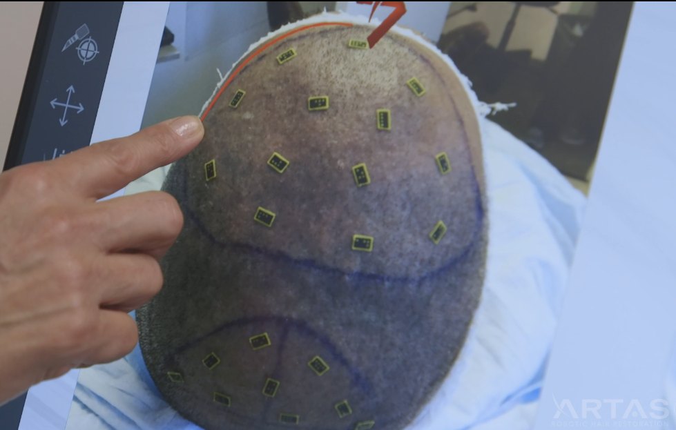 ARTAS iX recipient site plan mapped across a patient scalp during robotic FUE planning