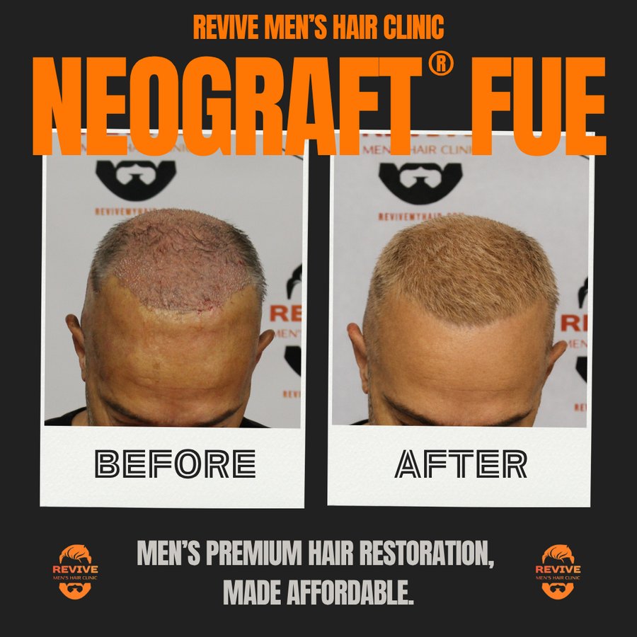 NeoGraft® FUE before and after, patient 1 of 36 — actual Revive Men’s Hair Clinic patient