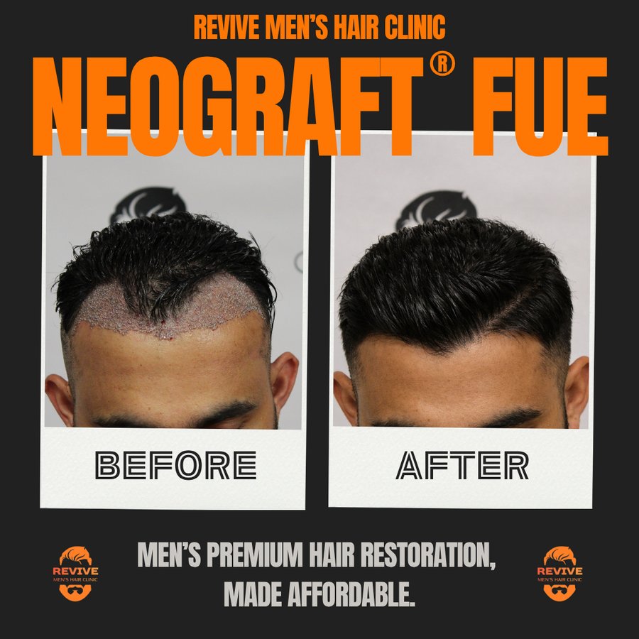 NeoGraft® FUE before and after, patient 2 of 36 — actual Revive Men’s Hair Clinic patient