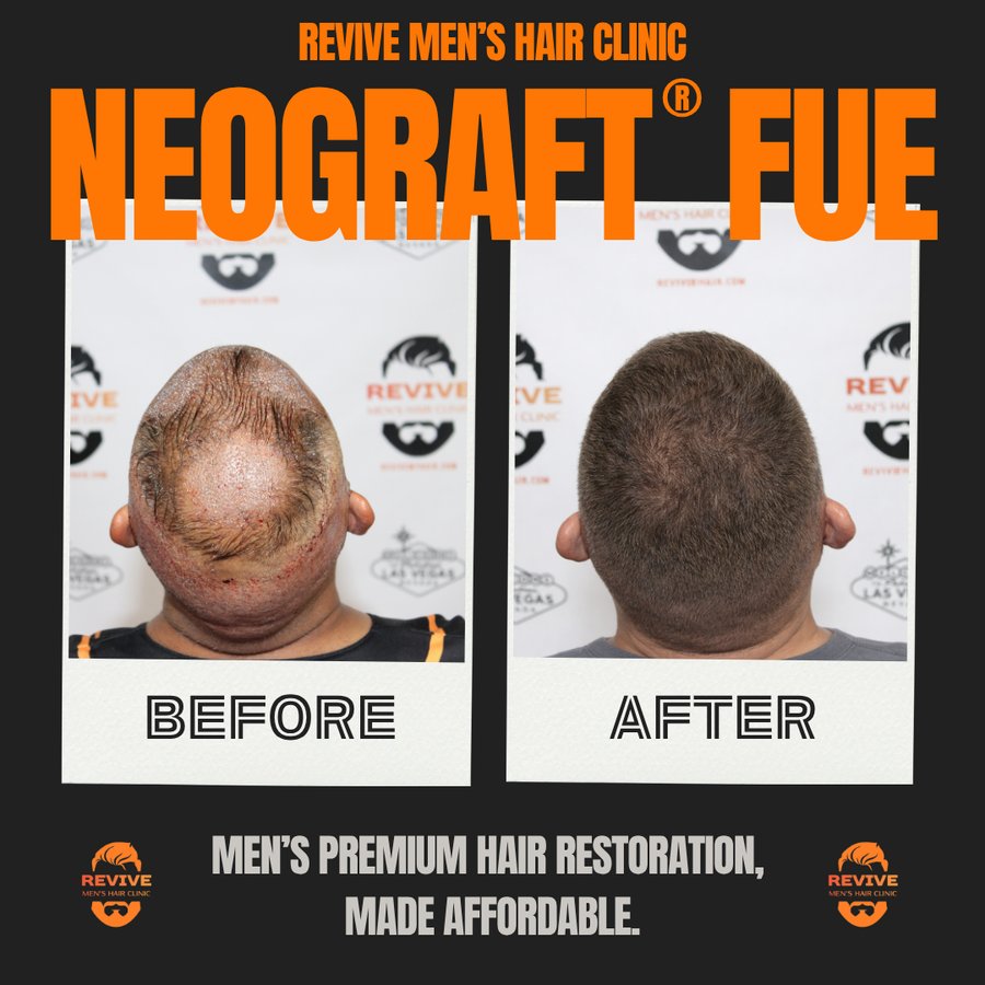 NeoGraft® FUE before and after, patient 3 of 36 — actual Revive Men’s Hair Clinic patient