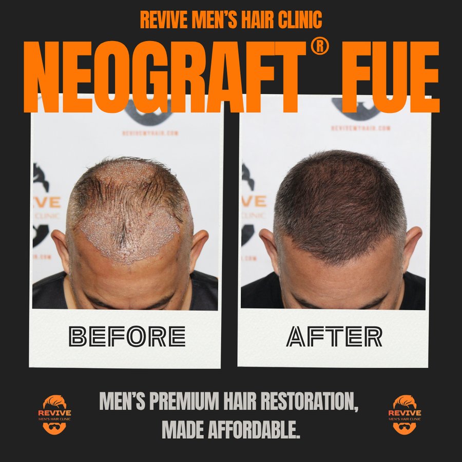 NeoGraft® FUE before and after, patient 4 of 36 — actual Revive Men’s Hair Clinic patient