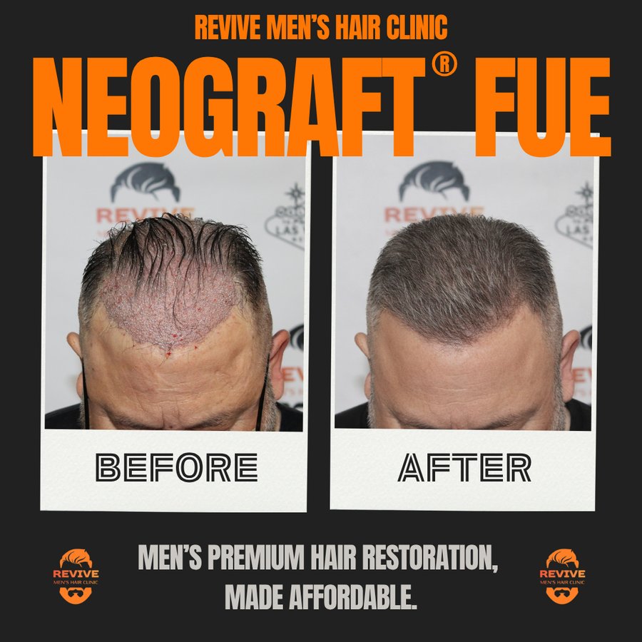 NeoGraft® FUE before and after, patient 5 of 36 — actual Revive Men’s Hair Clinic patient