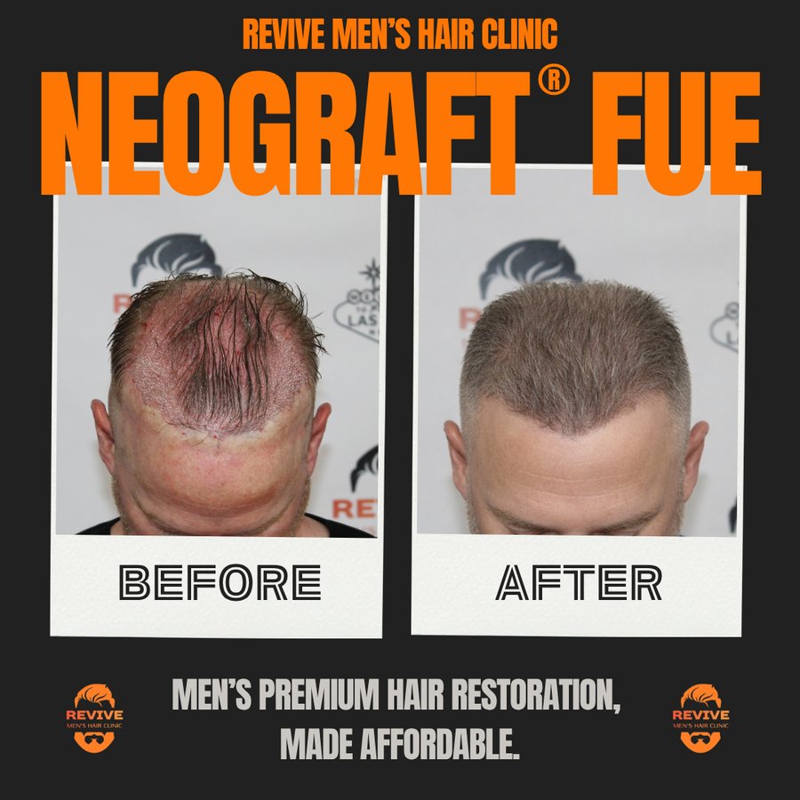 NeoGraft® FUE before and after, patient 6 of 36 — actual Revive Men’s Hair Clinic patient