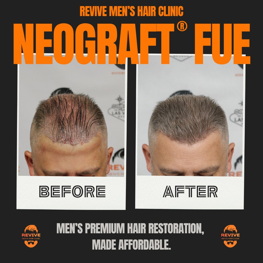 NeoGraft® FUE before and after, patient 7 of 36 — actual Revive Men’s Hair Clinic patient