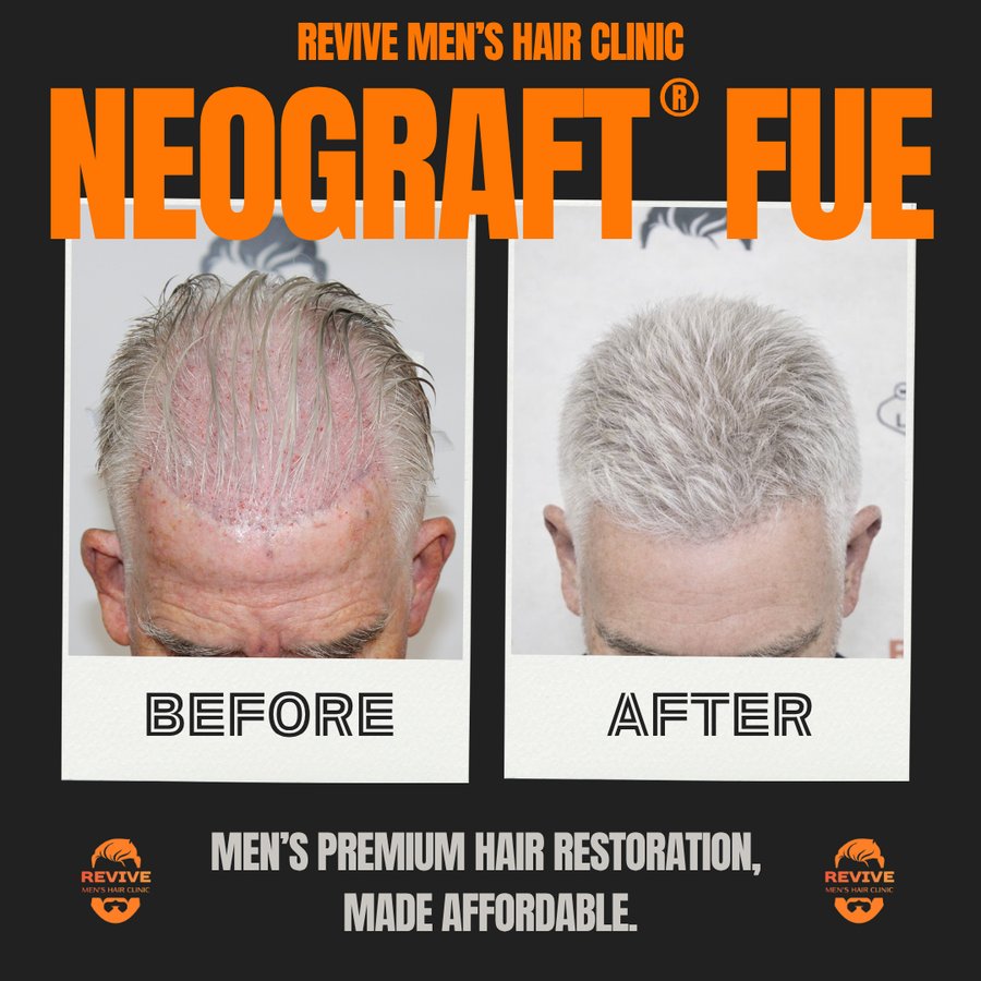NeoGraft® FUE before and after, patient 8 of 36 — actual Revive Men’s Hair Clinic patient