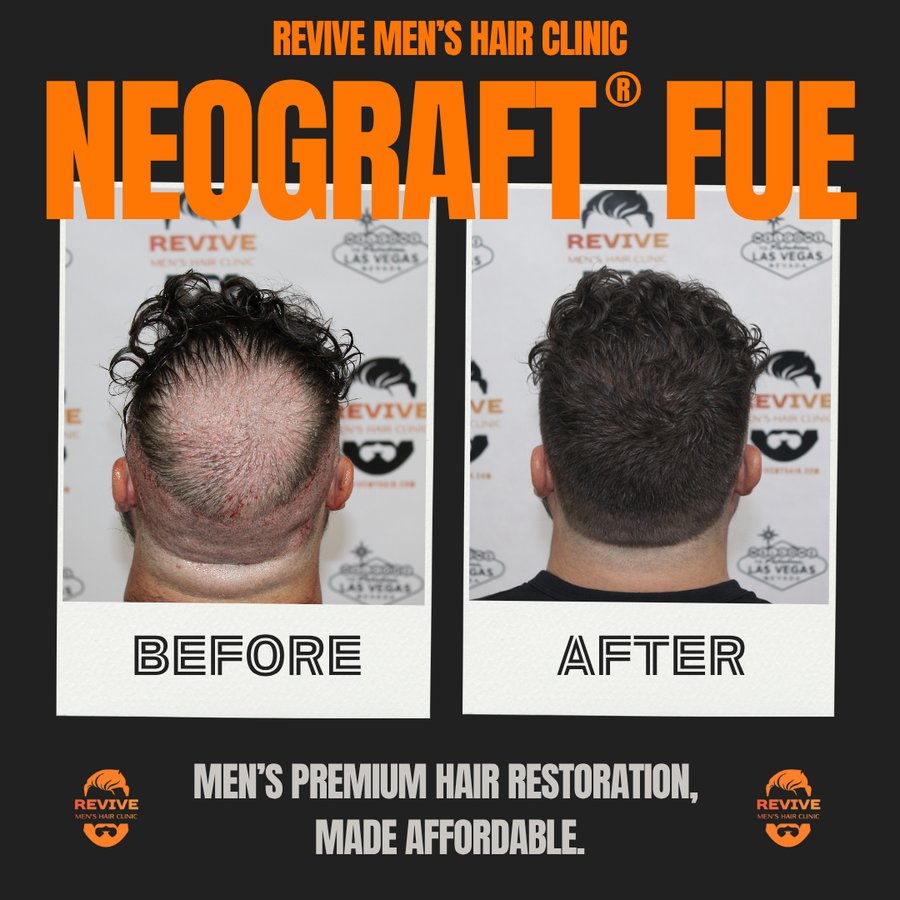 NeoGraft® FUE before and after, patient 9 of 36 — actual Revive Men’s Hair Clinic patient