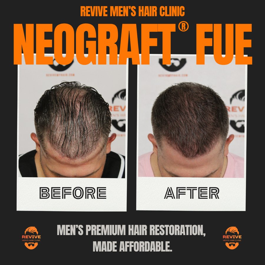 NeoGraft® FUE before and after, patient 10 of 36 — actual Revive Men’s Hair Clinic patient