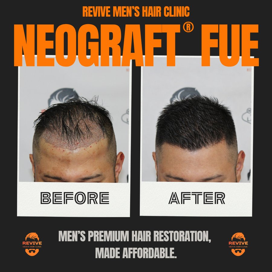 NeoGraft® FUE before and after, patient 11 of 36 — actual Revive Men’s Hair Clinic patient