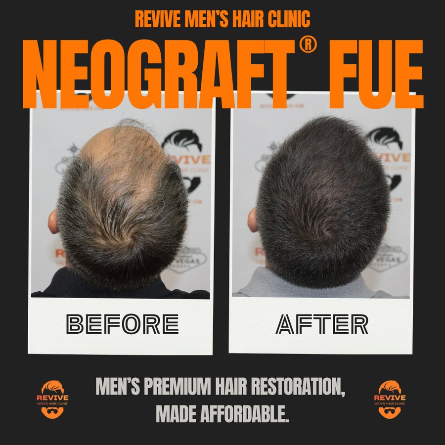 NeoGraft® FUE before and after, patient 12 of 36 — actual Revive Men’s Hair Clinic patient