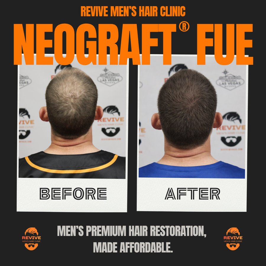 NeoGraft® FUE before and after, patient 13 of 36 — actual Revive Men’s Hair Clinic patient