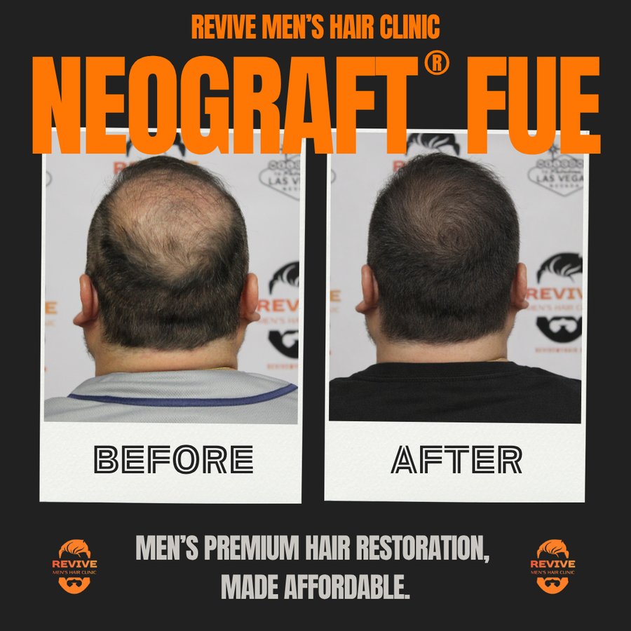 NeoGraft® FUE before and after, patient 14 of 36 — actual Revive Men’s Hair Clinic patient