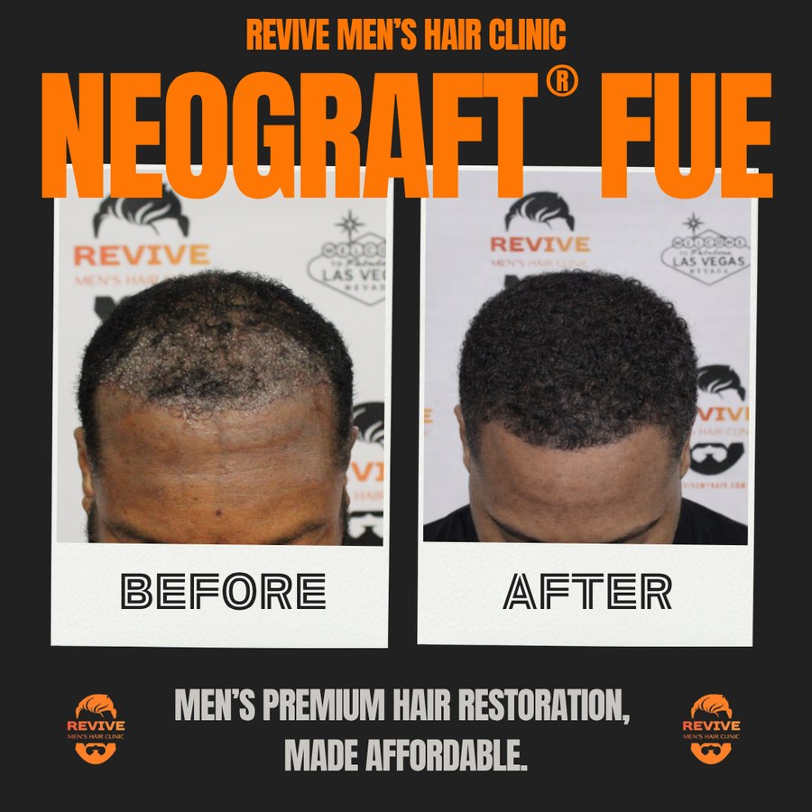 NeoGraft® FUE before and after, patient 15 of 36 — actual Revive Men’s Hair Clinic patient