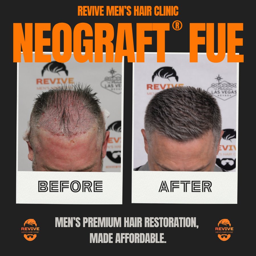 NeoGraft® FUE before and after, patient 16 of 36 — actual Revive Men’s Hair Clinic patient