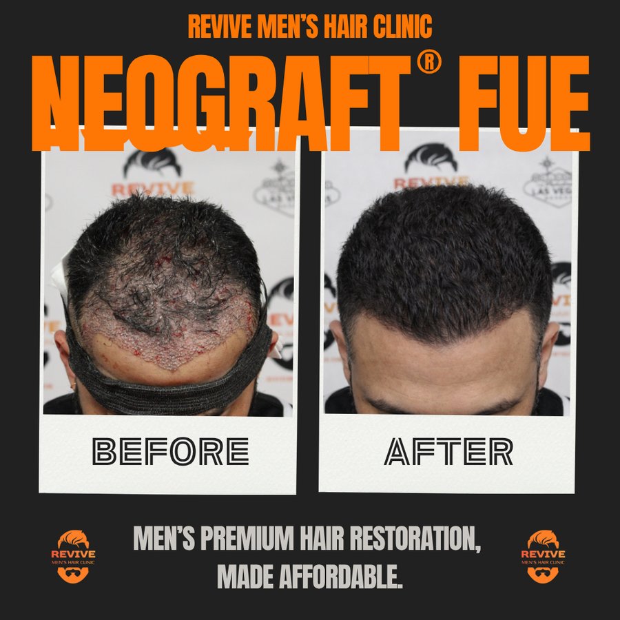 NeoGraft® FUE before and after, patient 17 of 36 — actual Revive Men’s Hair Clinic patient