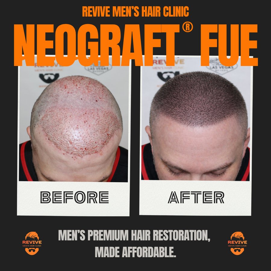 NeoGraft® FUE before and after, patient 18 of 36 — actual Revive Men’s Hair Clinic patient