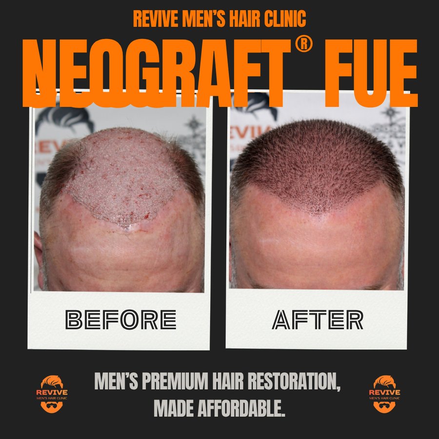 NeoGraft® FUE before and after, patient 19 of 36 — actual Revive Men’s Hair Clinic patient