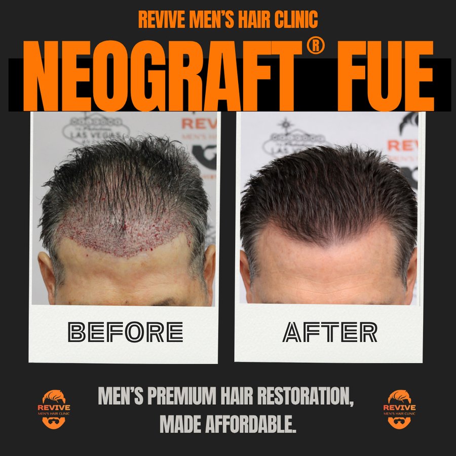 NeoGraft® FUE before and after, patient 20 of 36 — actual Revive Men’s Hair Clinic patient