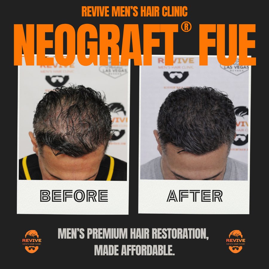 NeoGraft® FUE before and after, patient 21 of 36 — actual Revive Men’s Hair Clinic patient