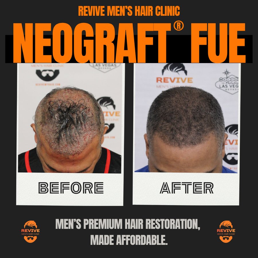 NeoGraft® FUE before and after, patient 22 of 36 — actual Revive Men’s Hair Clinic patient