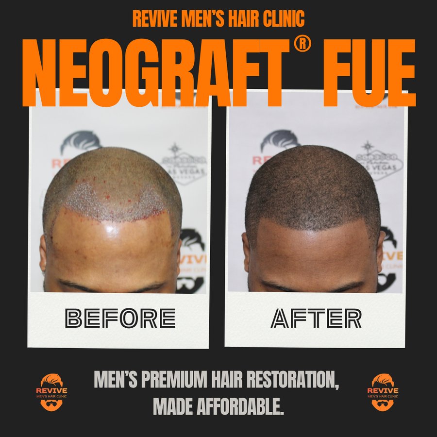 NeoGraft® FUE before and after, patient 23 of 36 — actual Revive Men’s Hair Clinic patient