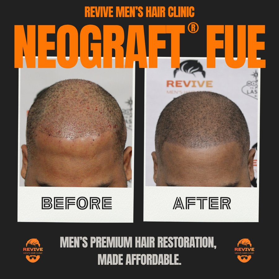 NeoGraft® FUE before and after, patient 24 of 36 — actual Revive Men’s Hair Clinic patient