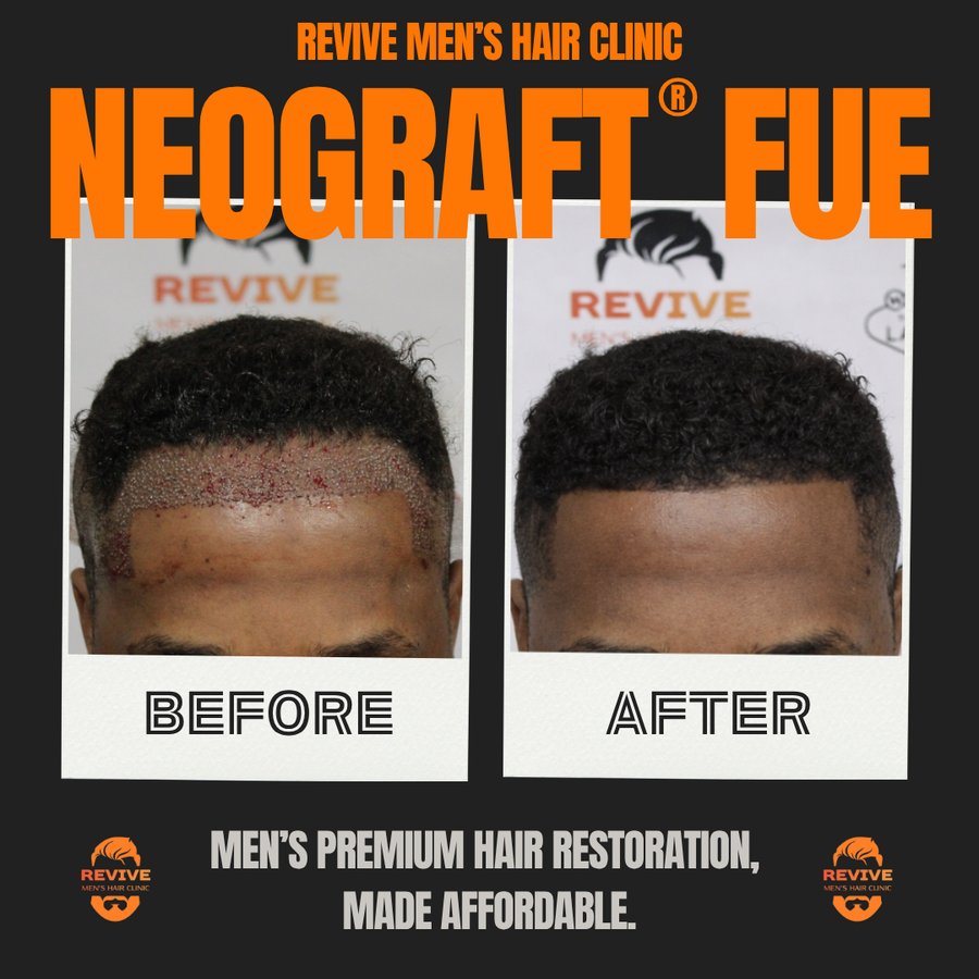 NeoGraft® FUE before and after, patient 25 of 36 — actual Revive Men’s Hair Clinic patient