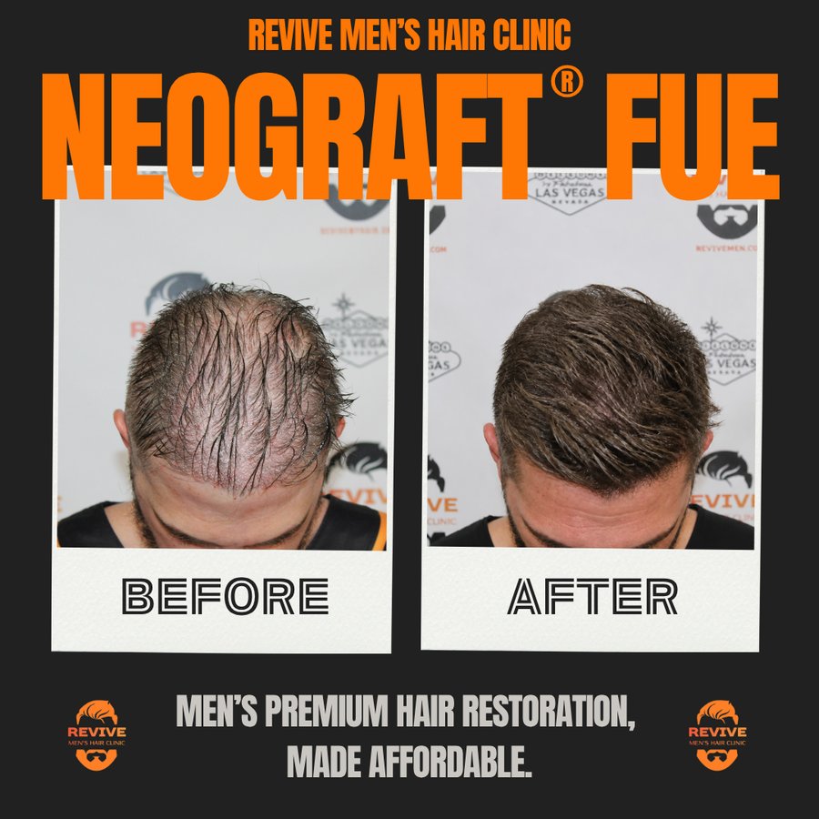 NeoGraft® FUE before and after, patient 26 of 36 — actual Revive Men’s Hair Clinic patient