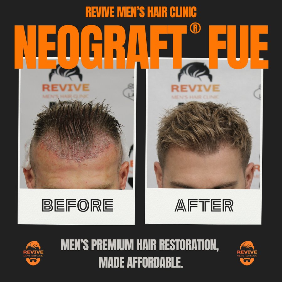 NeoGraft® FUE before and after, patient 27 of 36 — actual Revive Men’s Hair Clinic patient