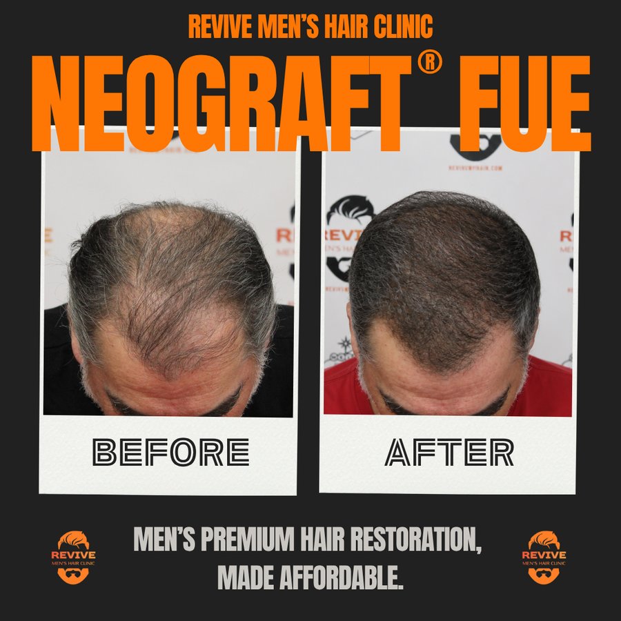 NeoGraft® FUE before and after, patient 28 of 36 — actual Revive Men’s Hair Clinic patient