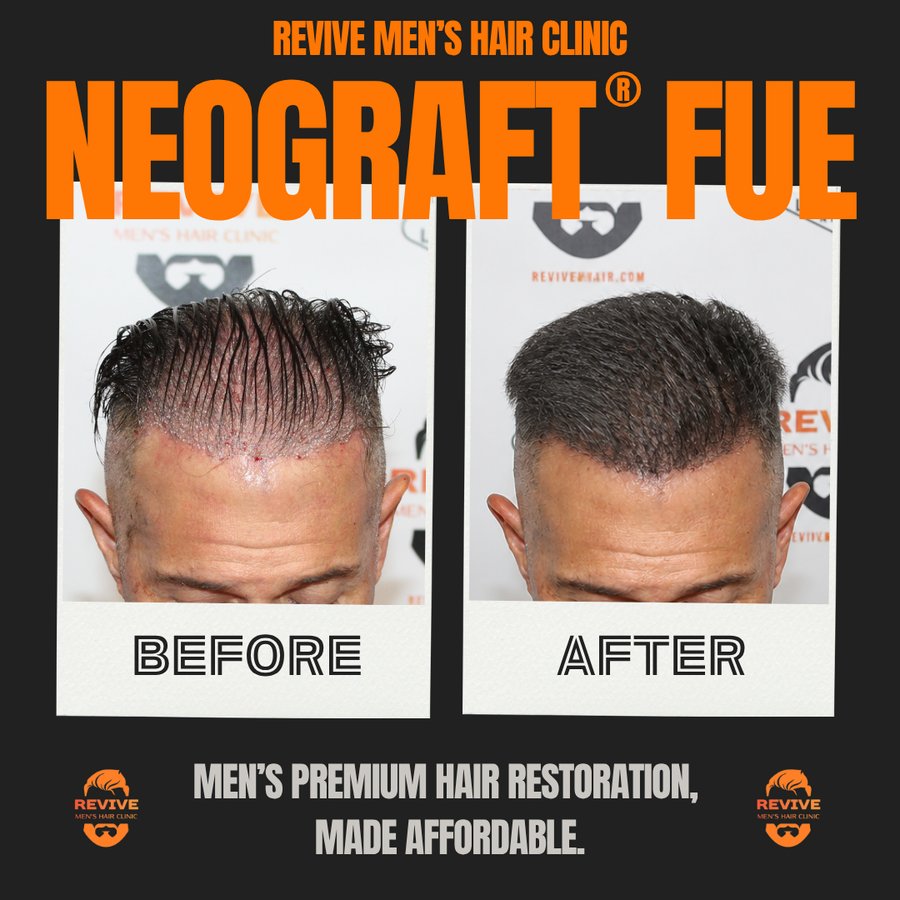 NeoGraft® FUE before and after, patient 29 of 36 — actual Revive Men’s Hair Clinic patient