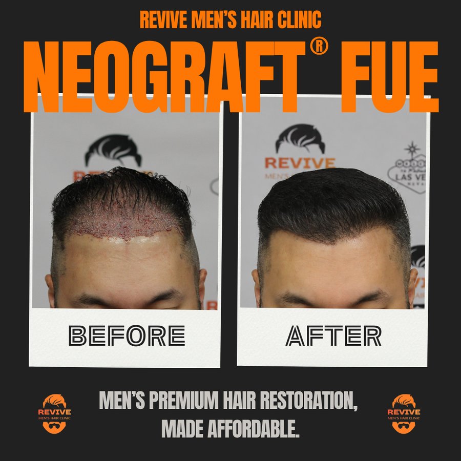 NeoGraft® FUE before and after, patient 30 of 36 — actual Revive Men’s Hair Clinic patient