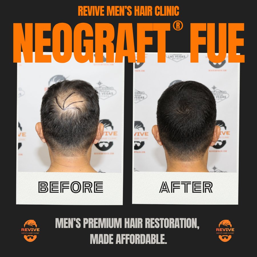 NeoGraft® FUE before and after, patient 31 of 36 — actual Revive Men’s Hair Clinic patient