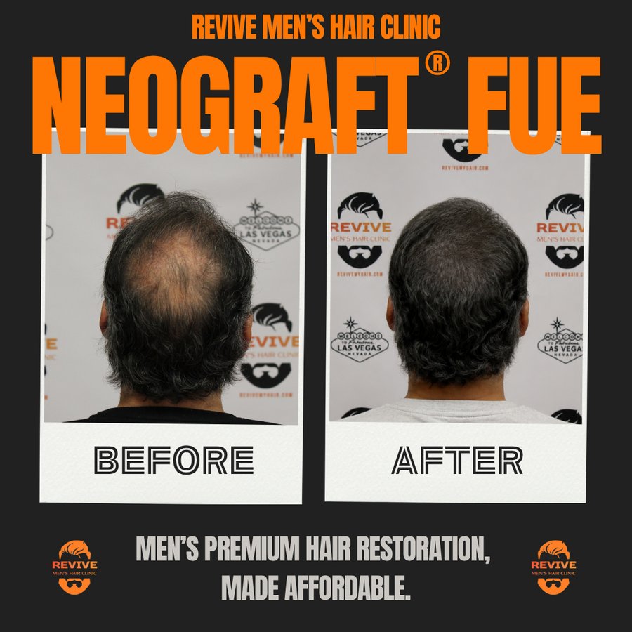 NeoGraft® FUE before and after, patient 32 of 36 — actual Revive Men’s Hair Clinic patient