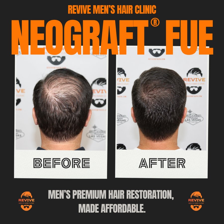 NeoGraft® FUE before and after, patient 33 of 36 — actual Revive Men’s Hair Clinic patient