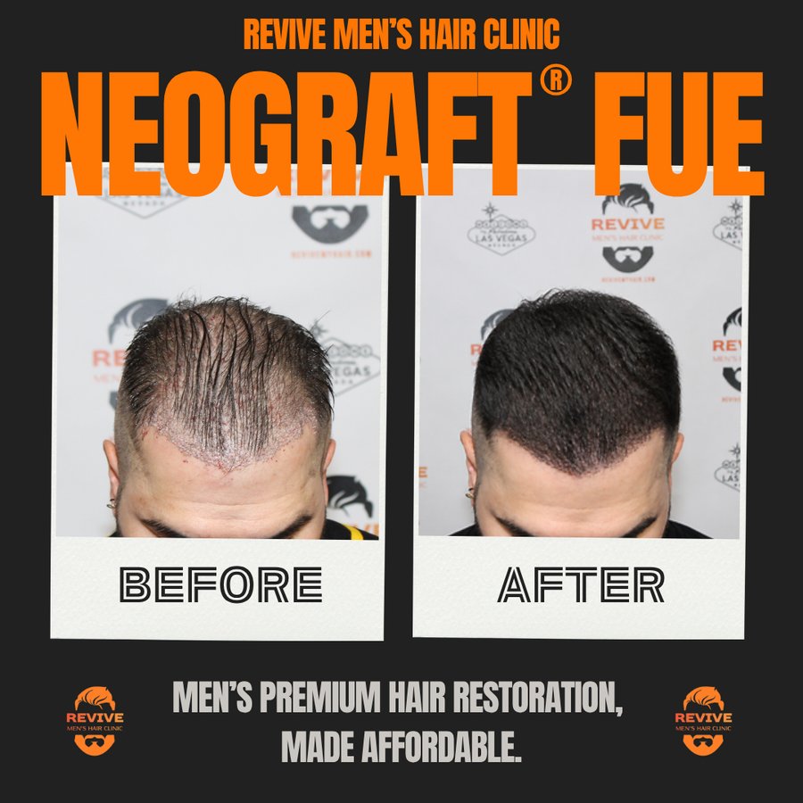 NeoGraft® FUE before and after, patient 34 of 36 — actual Revive Men’s Hair Clinic patient