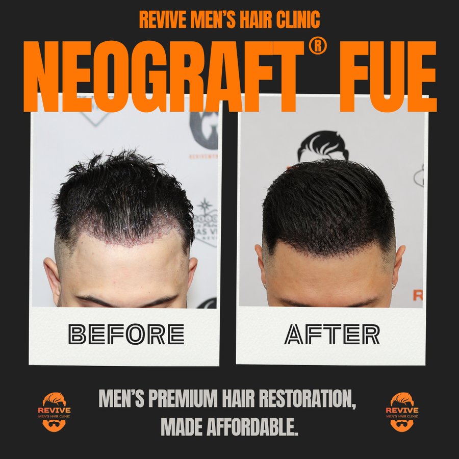 NeoGraft® FUE before and after, patient 35 of 36 — actual Revive Men’s Hair Clinic patient