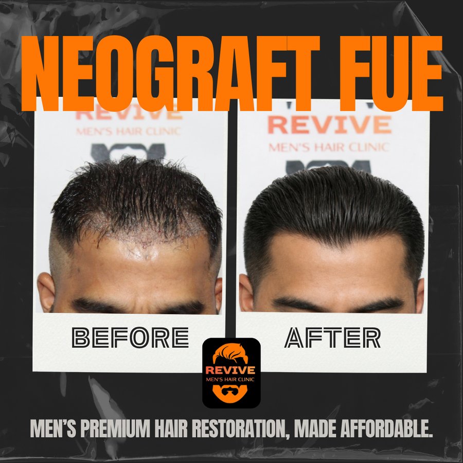 NeoGraft® FUE before and after, patient 36 of 36 — actual Revive Men’s Hair Clinic patient