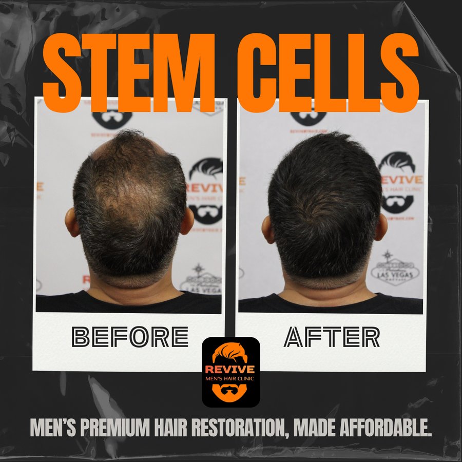 The Revive Protocol before and after, patient 1 of 12 — actual Revive Men’s Hair Clinic patient