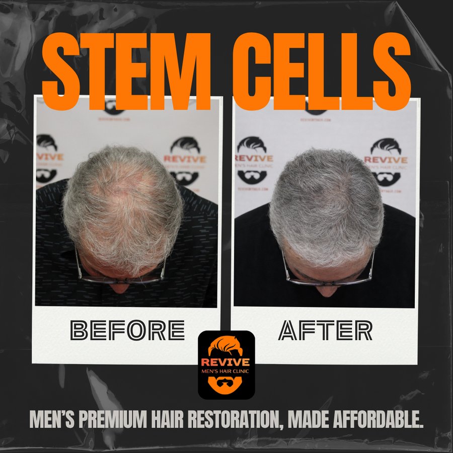 The Revive Protocol before and after, patient 2 of 12 — actual Revive Men’s Hair Clinic patient