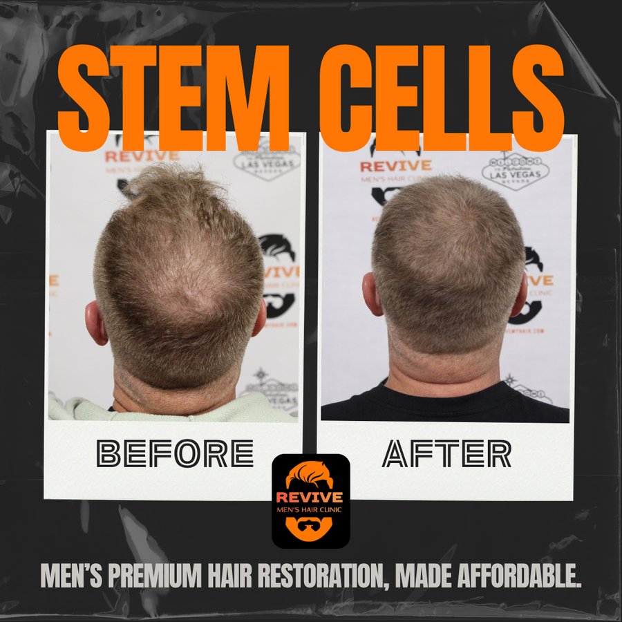 The Revive Protocol before and after, patient 3 of 12 — actual Revive Men’s Hair Clinic patient