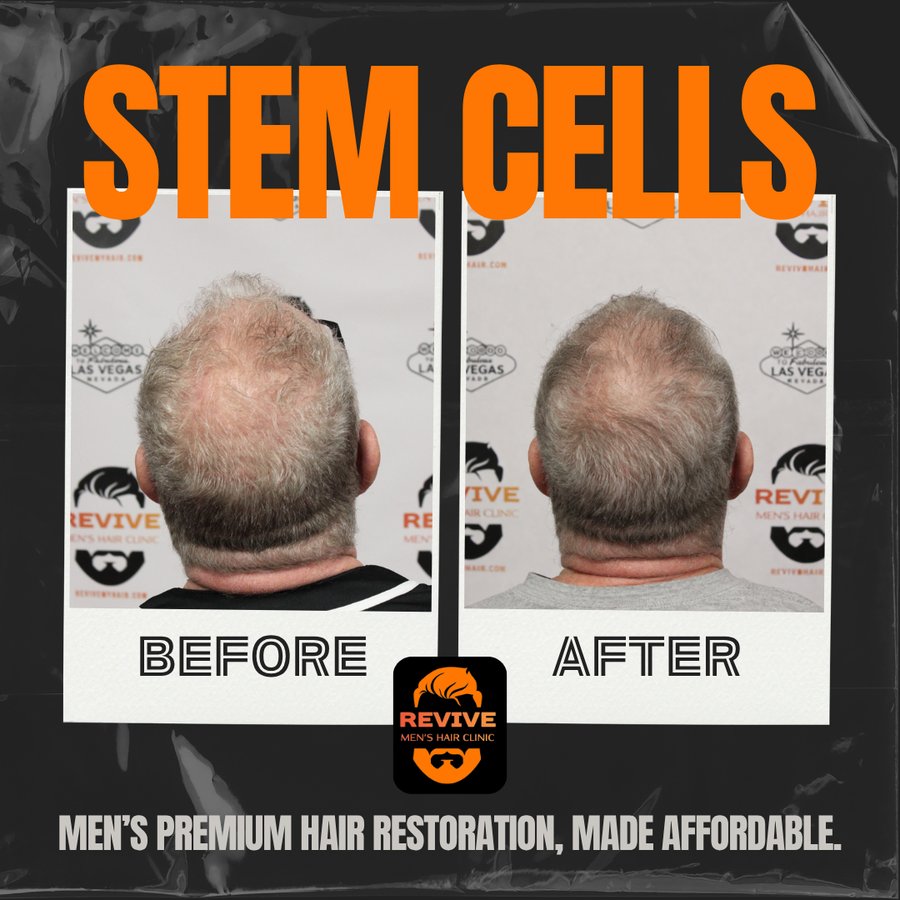 The Revive Protocol before and after, patient 4 of 12 — actual Revive Men’s Hair Clinic patient