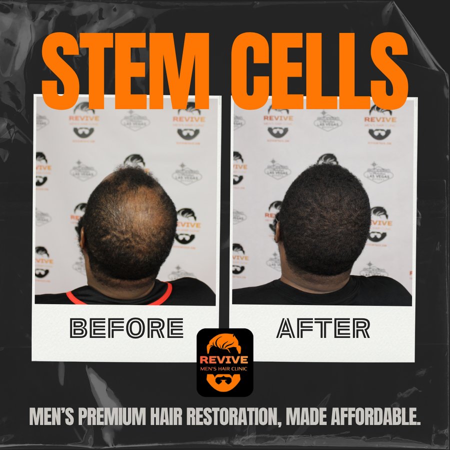 The Revive Protocol before and after, patient 5 of 12 — actual Revive Men’s Hair Clinic patient